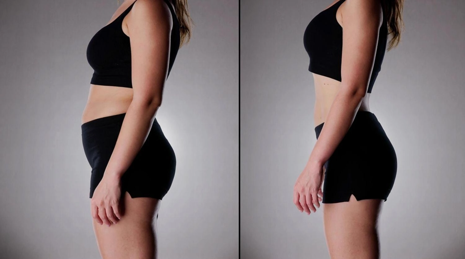 Resultados Antes y después de eliminar la adiposidad localizada del abdomen